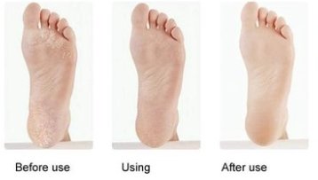 Voor en na resultaat FootSmooth